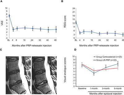 Application of platelet-rich plasma in spinal surgery